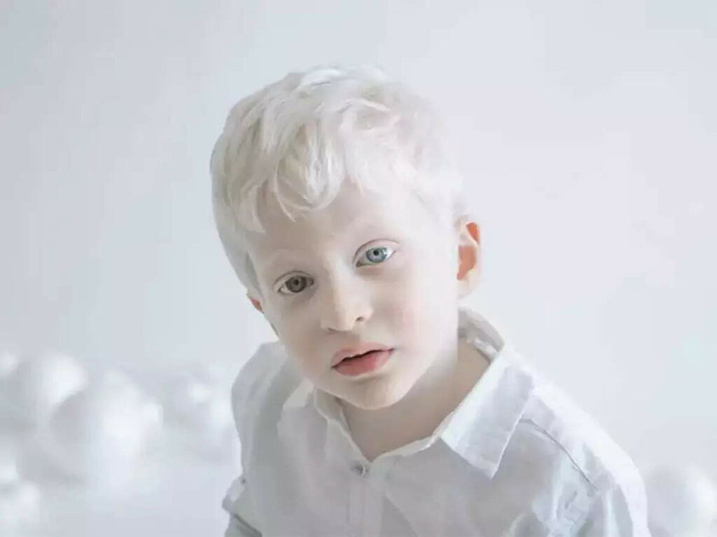 Albinizm _ dziecko