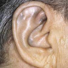 Akaptonuria ucho