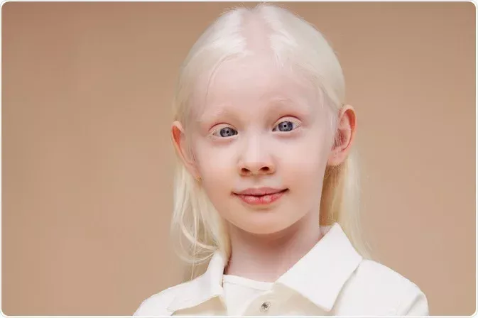 Dziewczynka chora na albinizm