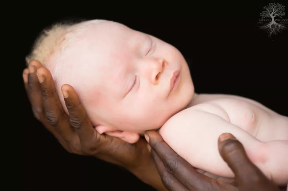 Dziecko Albinos